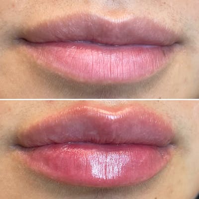 Full Pout® Before & After Gallery - Patient 148023256 - Image 1