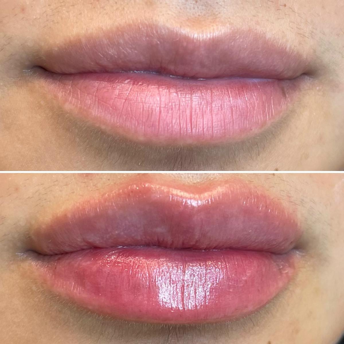 Full Pout® Before & After Gallery - Patient 148023256 - Image 1