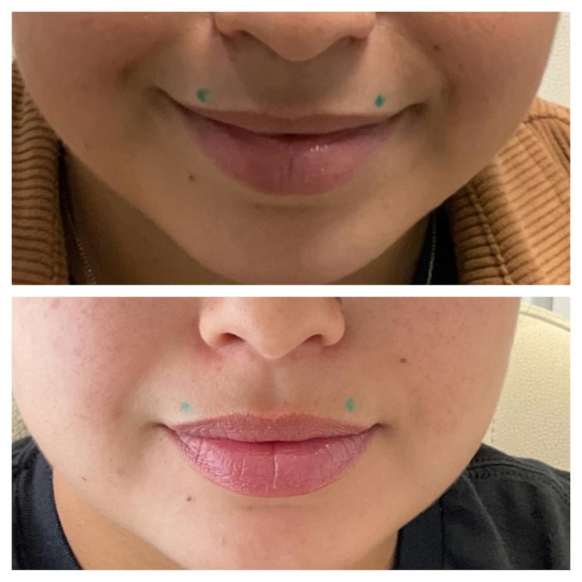 Lip Flip  Before & After Gallery - Patient 148023326 - Image 1