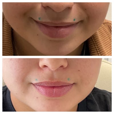 Lip Flip  Before & After Gallery - Patient 148023326 - Image 1