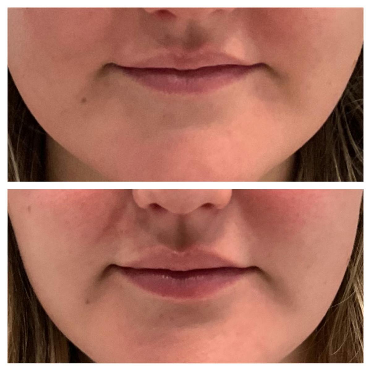 Lip Flip  Before & After Gallery - Patient 148023327 - Image 1