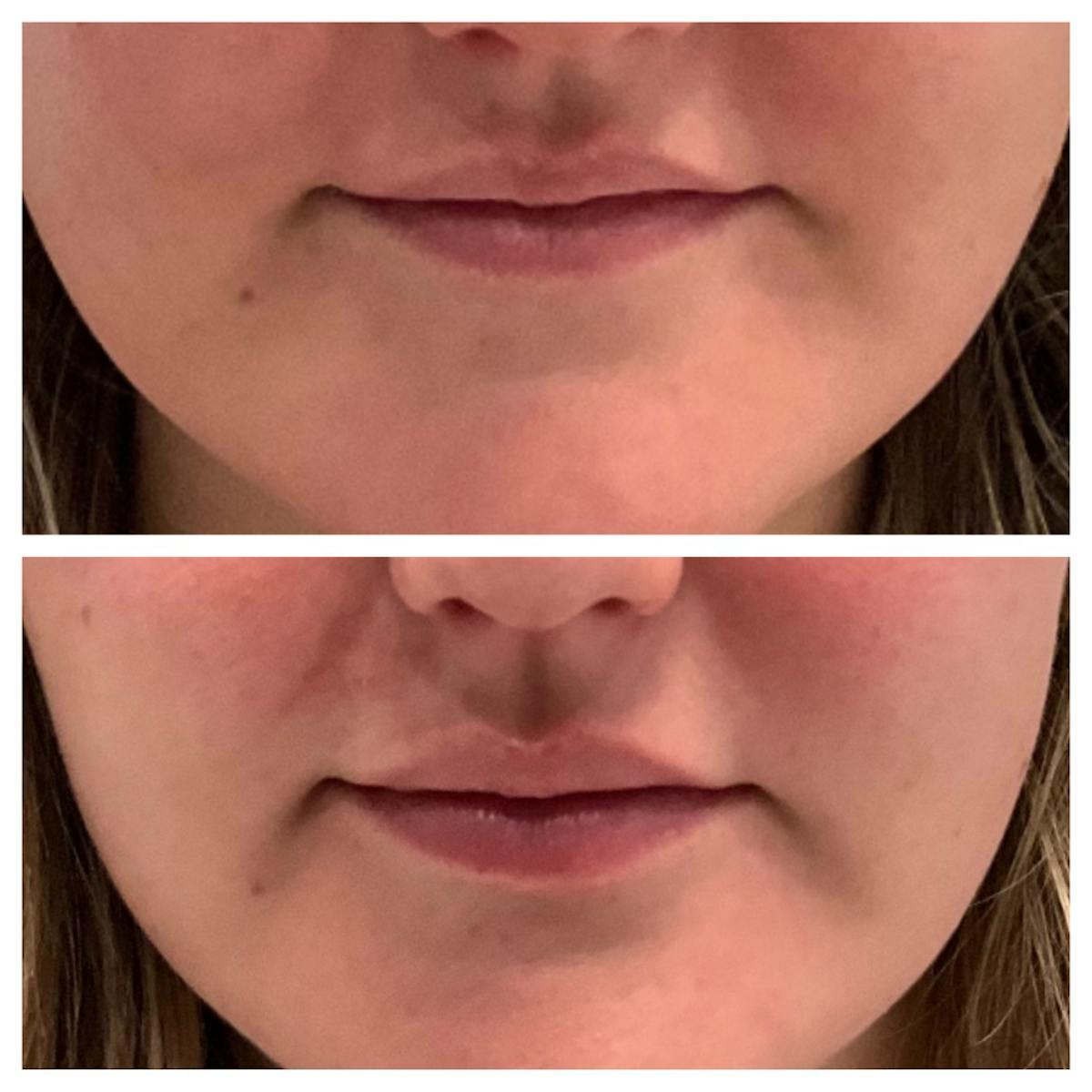 Lip Flip  Before & After Gallery - Patient 148023327 - Image 1