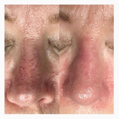ThermaVein® Before & After Gallery - Patient 148466668 - Image 1