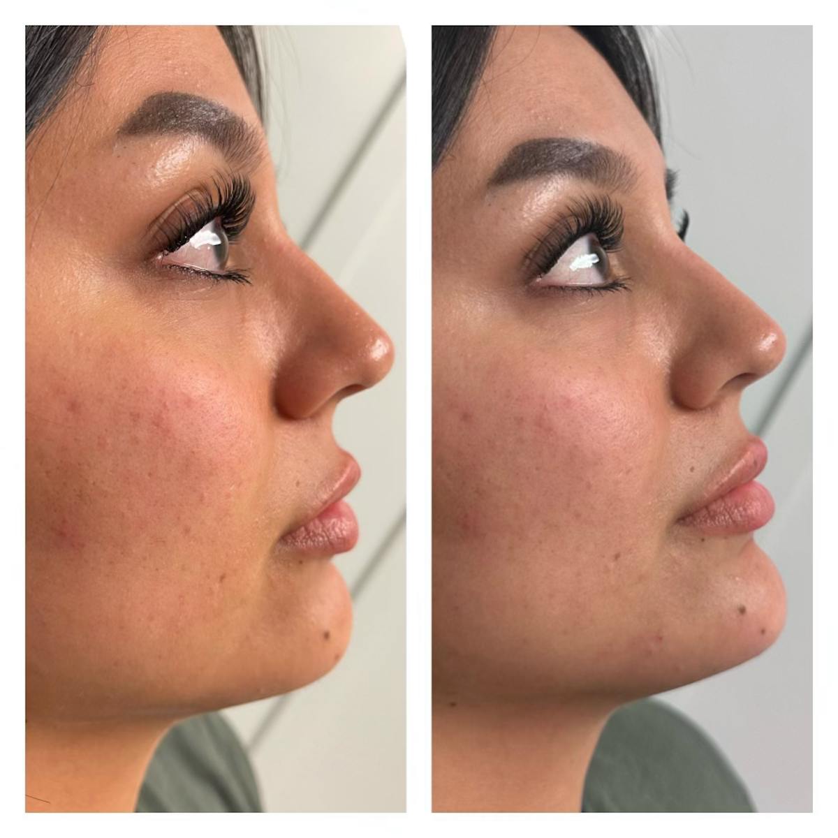 Dermal Fillers Before & After Gallery - Patient 148703185 - Image 2