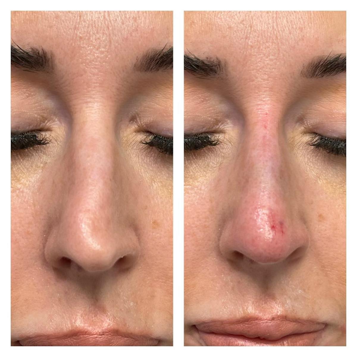 Non-Surgical Rhinoplasty Before & After Gallery - Patient 148703187 - Image 1