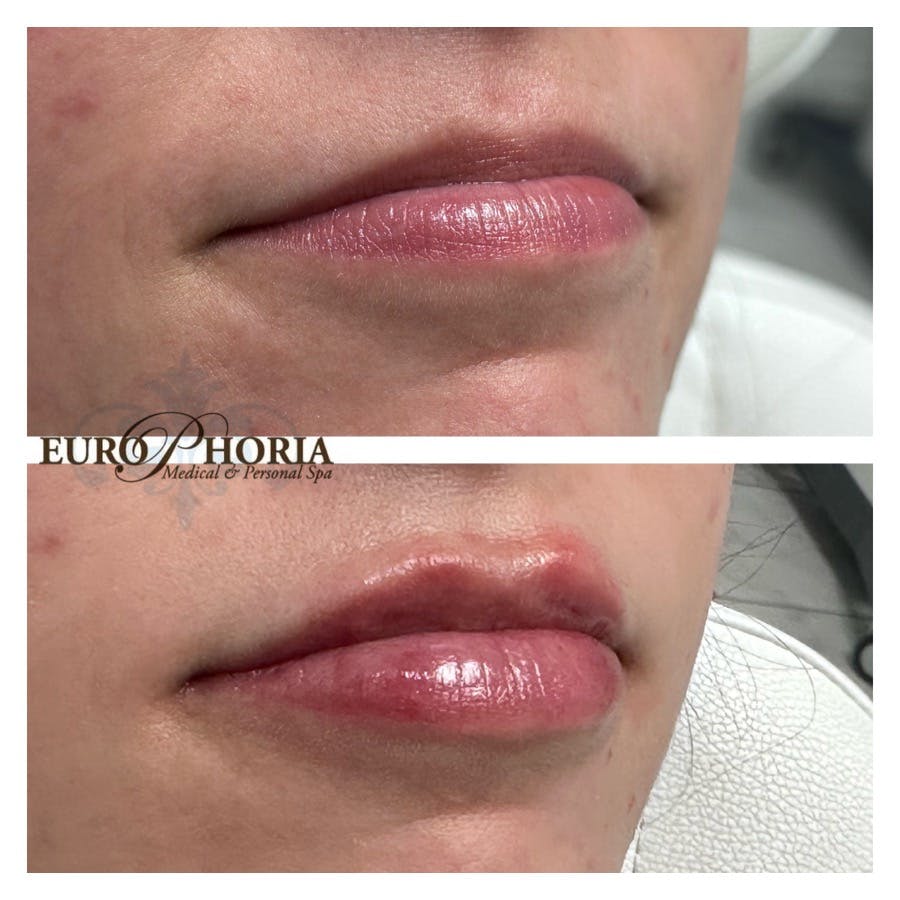 Petite Pout® Before & After Gallery - Patient 148703188 - Image 1