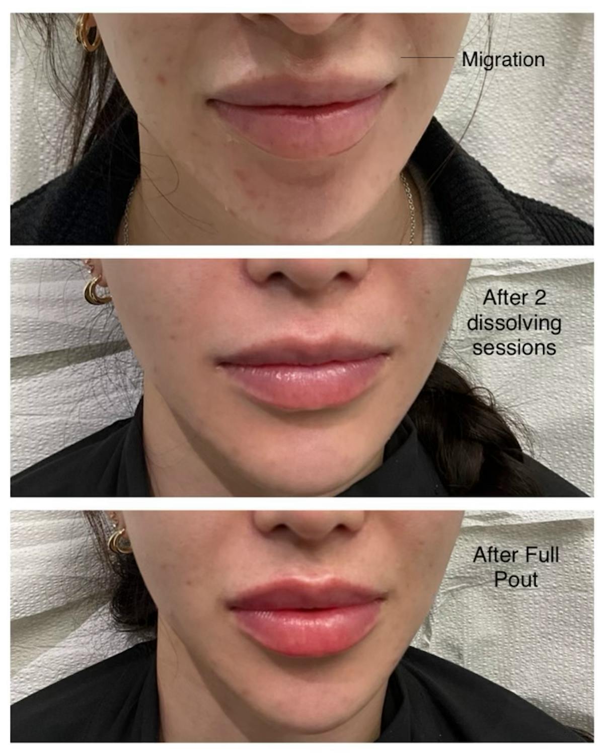 Full Pout® Before & After Gallery - Patient 167794781 - Image 1