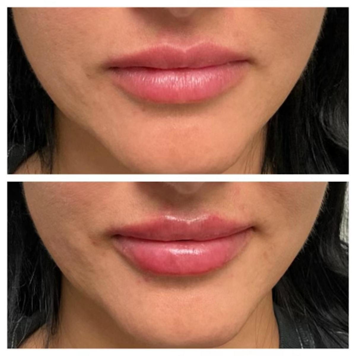 Full Pout® Before & After Gallery - Patient 167794779 - Image 1