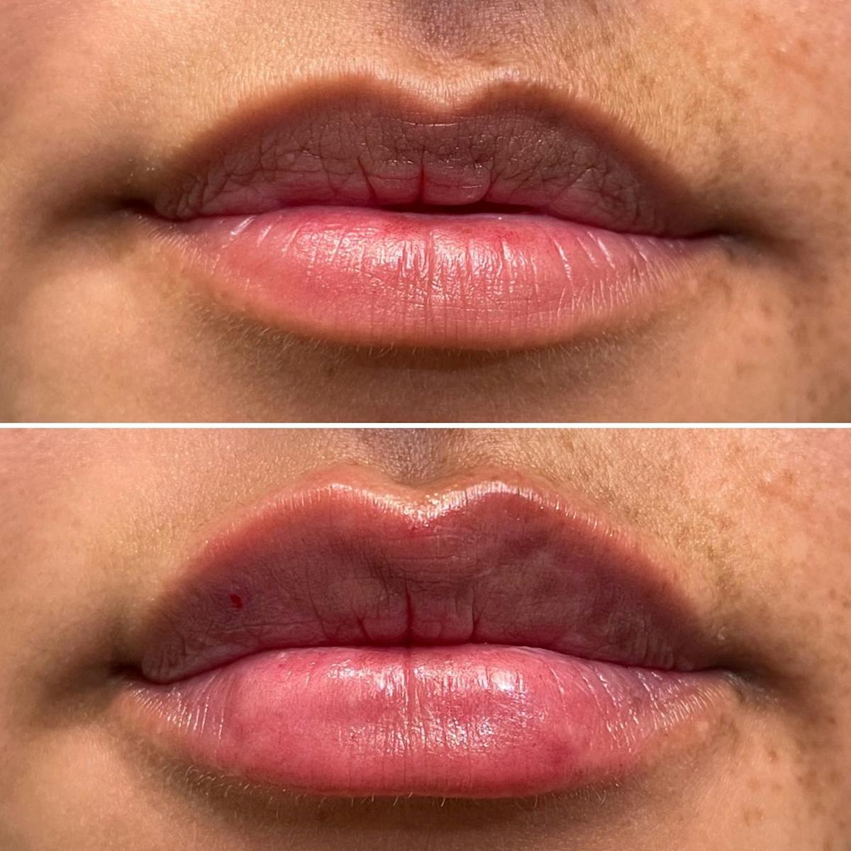 Full Pout® Before & After Gallery - Patient 167794780 - Image 1