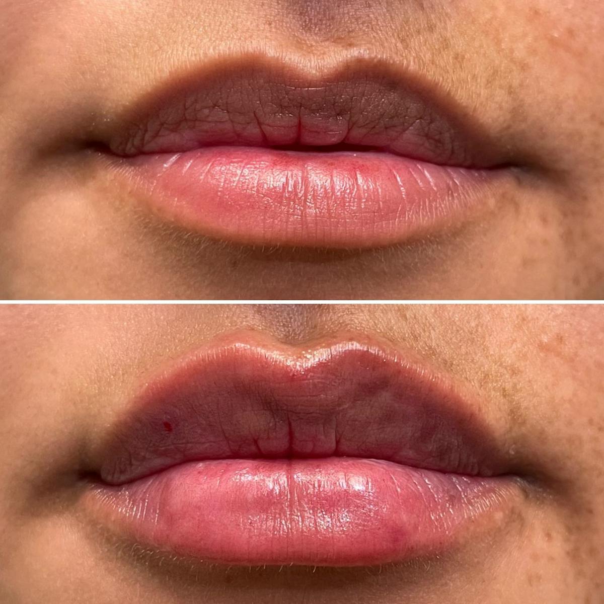 Full Pout® Before & After Gallery - Patient 167794780 - Image 1