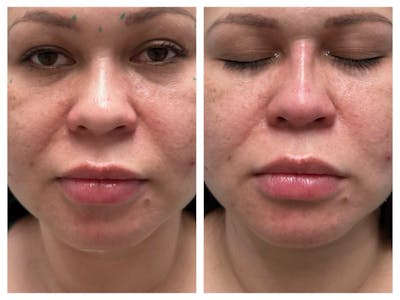 Non-Surgical Rhinoplasty Before & After Gallery - Patient 167794783 - Image 1