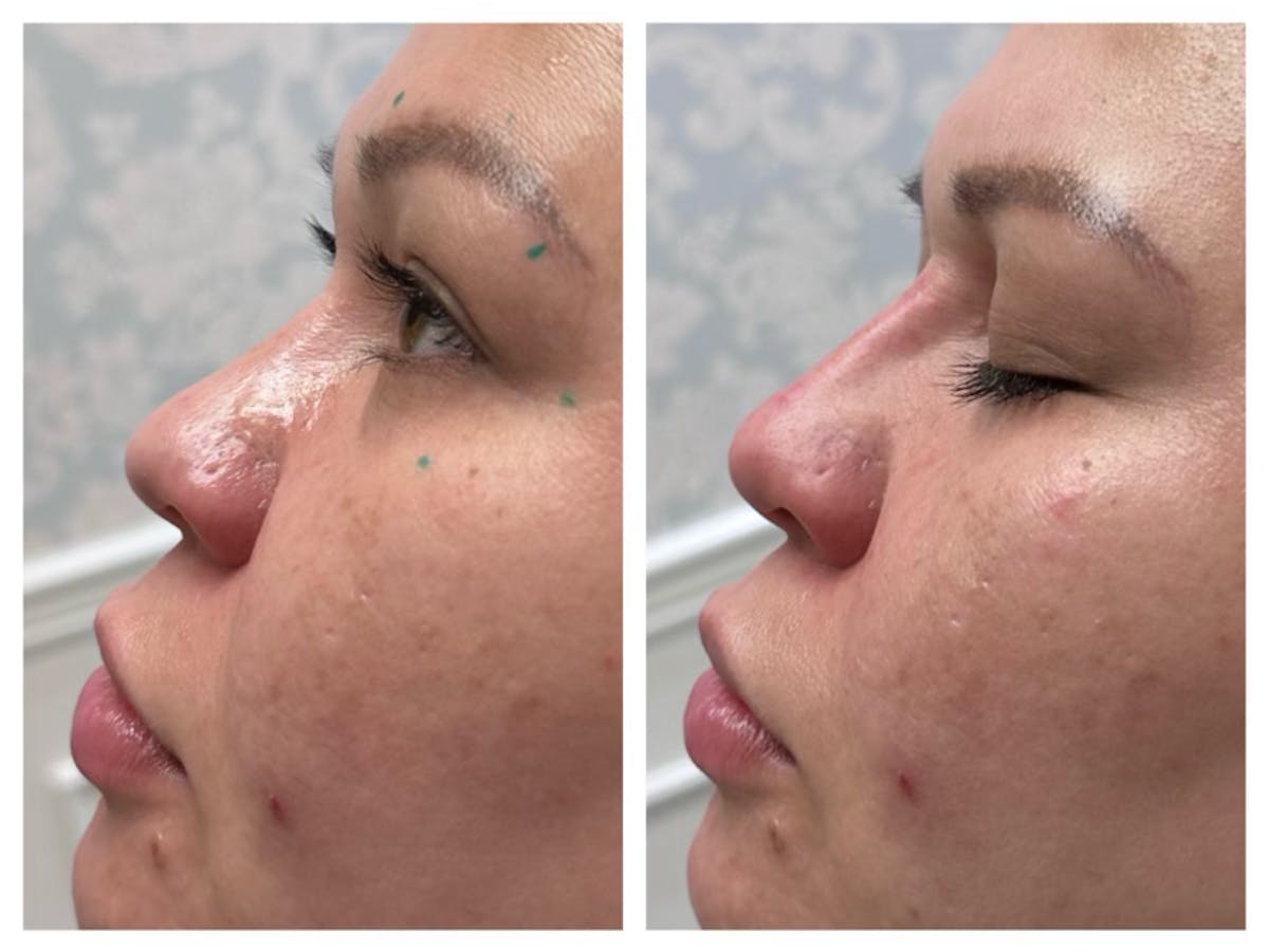 Non-Surgical Rhinoplasty Before & After Gallery - Patient 167794783 - Image 2