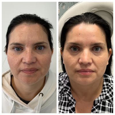 BBL® MOXI™ Before & After Gallery - Patient 451257 - Image 1