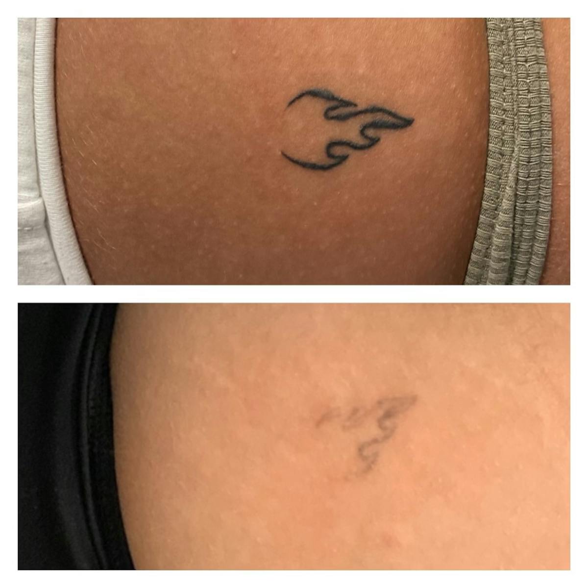 No RAGRETS Laser Tattoo Removal™ Before & After Gallery - Patient 346769 - Image 1