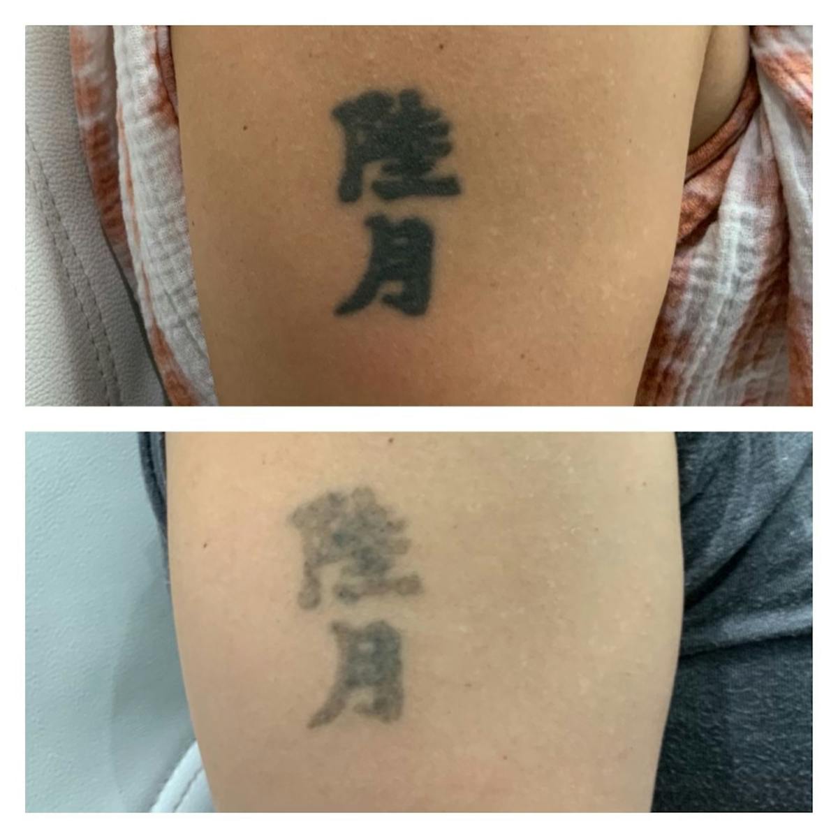 No RAGRETS Laser Tattoo Removal™ Before & After Gallery - Patient 213284 - Image 1