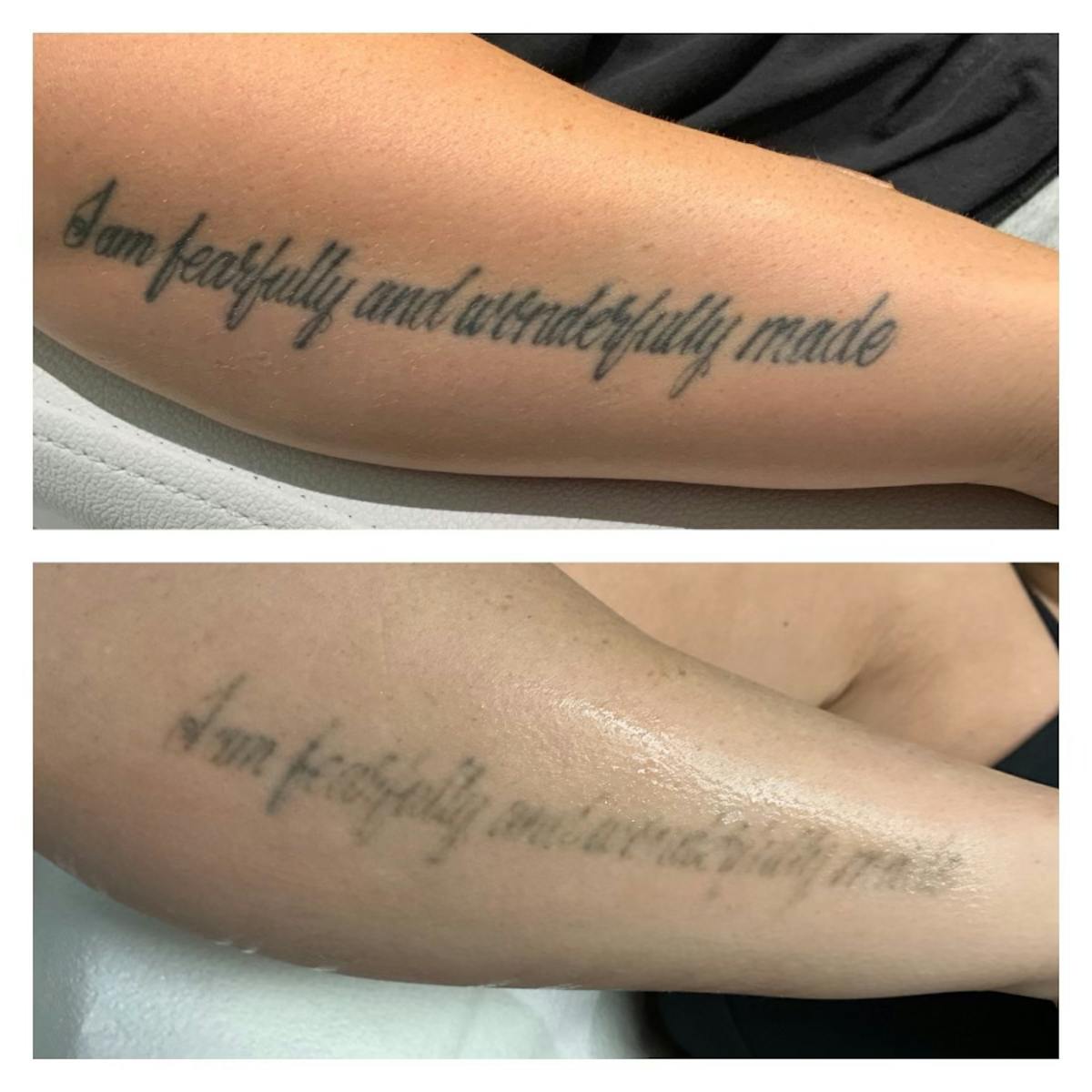 No RAGRETS Laser Tattoo Removal™ Before & After Gallery - Patient 317366 - Image 1