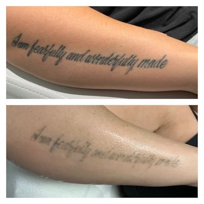 No RAGRETS Laser Tattoo Removal™ Before & After Gallery - Patient 317366 - Image 1