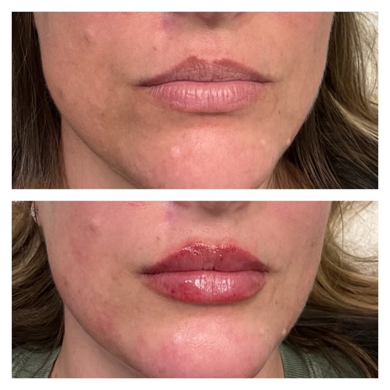 lip pout before and after