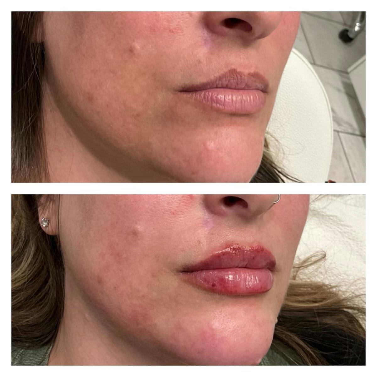 Petite Pout® Before & After Gallery - Patient 100012 - Image 2
