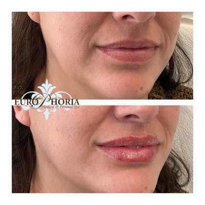Petite Pout® Before & After Gallery - Patient 235517 - Image 1
