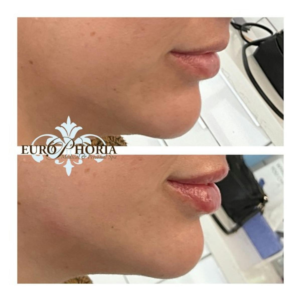 Petite Pout® Before & After Gallery - Patient 235517 - Image 2