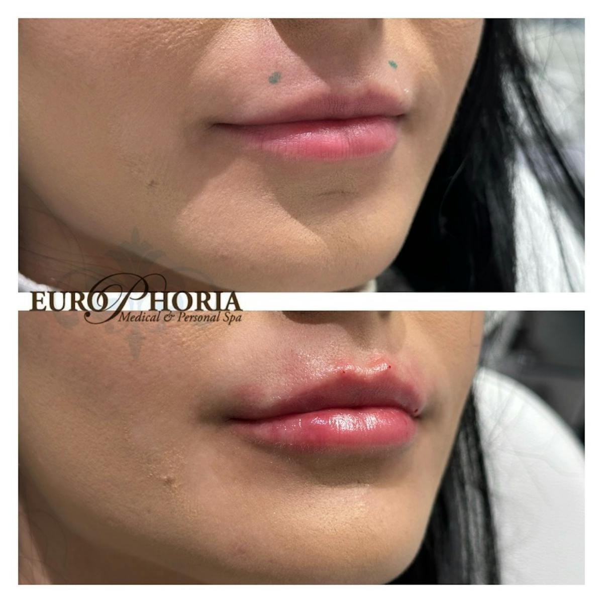 Petite Pout® Before & After Gallery - Patient 374344 - Image 1