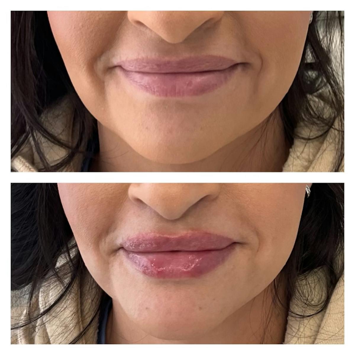 Petite Pout® Before & After Gallery - Patient 367167 - Image 1