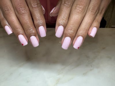 Signature Nail Treatments Before & After Gallery - Patient 314360 - Image 1