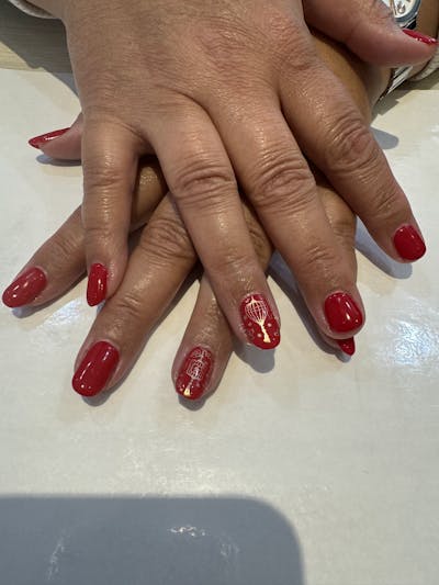 Signature Nail Treatments Before & After Gallery - Patient 107392 - Image 1