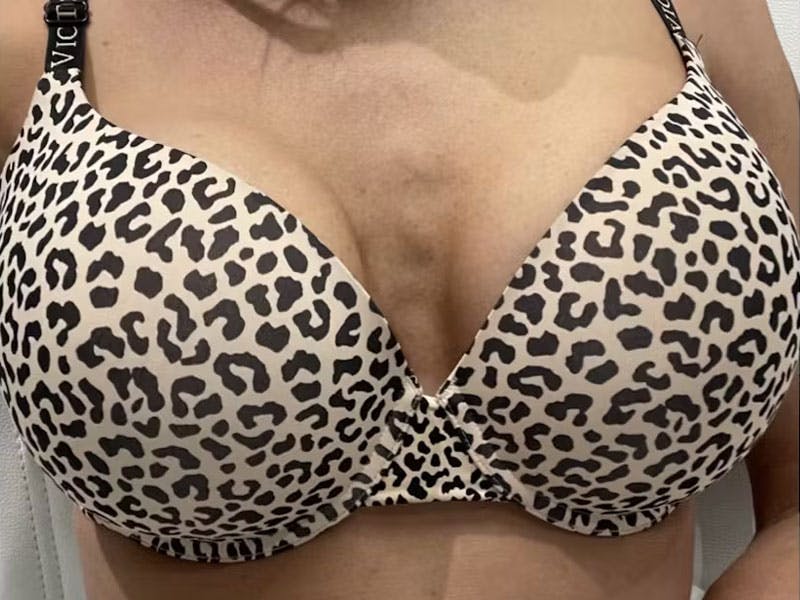 Before and After bust