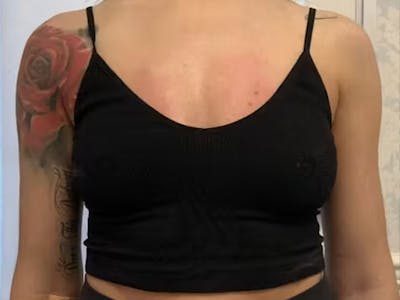 Before and After bust