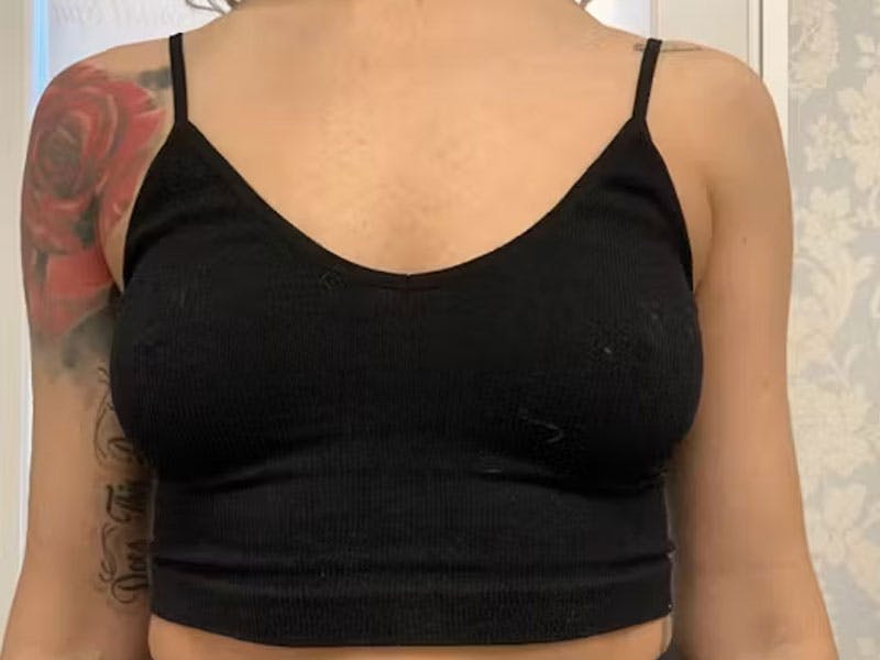 Before and After bust