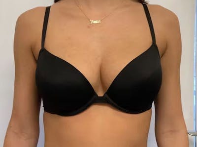 Before and After bust