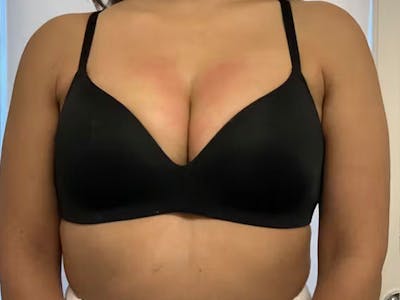 Before and After bust
