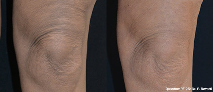 Before and After Knees