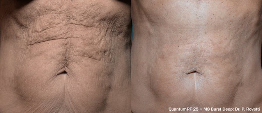 Before and After Tummy