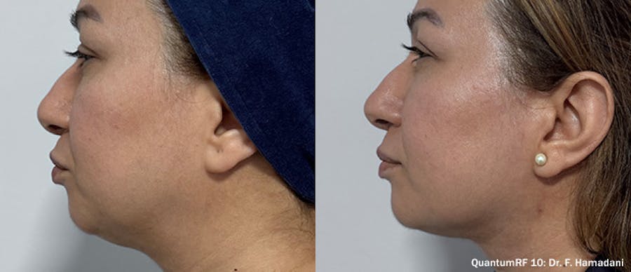 Before and After Side Profile