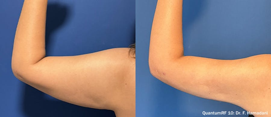 Before and After Arm