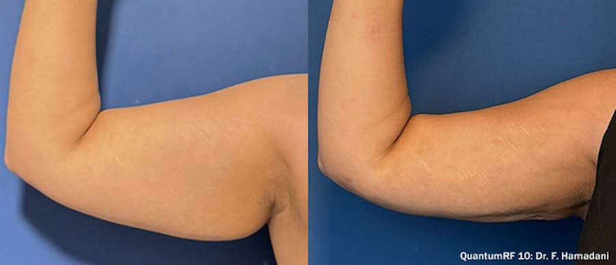 Before and After Arm