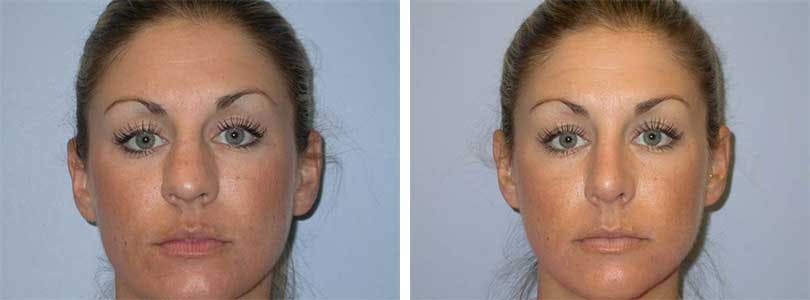 Rhinoplasty Before & After Gallery - Patient 74275501 - Image 1