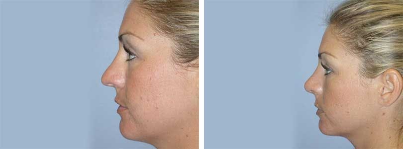 Rhinoplasty Before & After Gallery - Patient 74275501 - Image 2