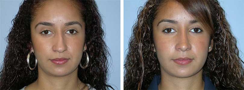 Rhinoplasty Before & After Gallery - Patient 74275502 - Image 1