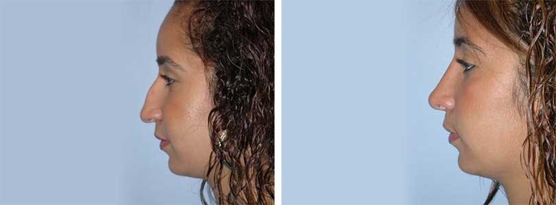 Rhinoplasty Before & After Gallery - Patient 74275502 - Image 2