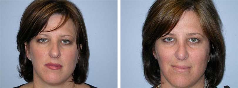 Rhinoplasty Before & After Gallery - Patient 74275506 - Image 1