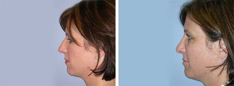 Rhinoplasty Before & After Gallery - Patient 74275506 - Image 2