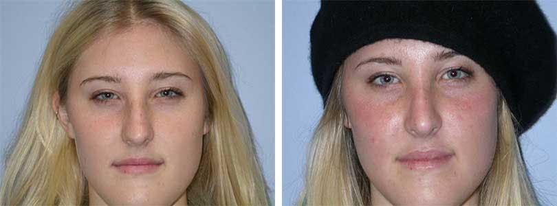 Rhinoplasty Before & After Gallery - Patient 74275507 - Image 1