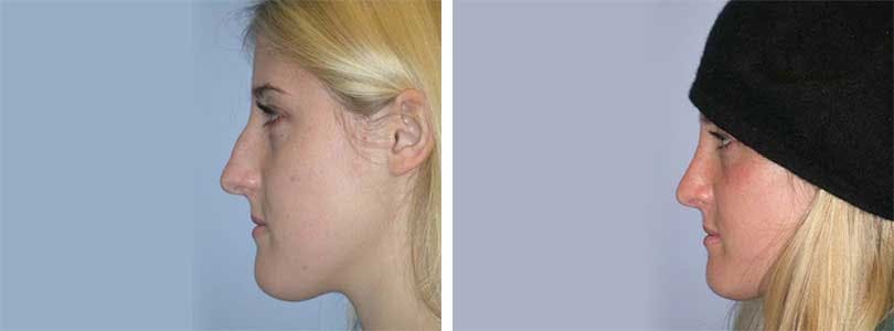 Rhinoplasty Before & After Gallery - Patient 74275507 - Image 2