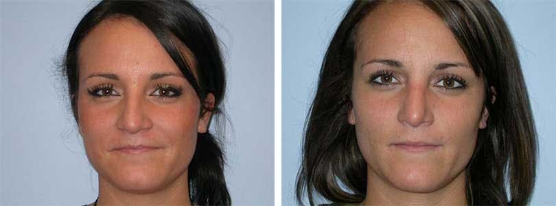 Rhinoplasty Before & After Gallery - Patient 74275509 - Image 1