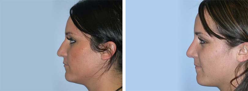 Rhinoplasty Before & After Gallery - Patient 74275509 - Image 2