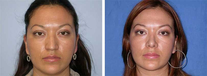 Rhinoplasty Before & After Gallery - Patient 74275510 - Image 1